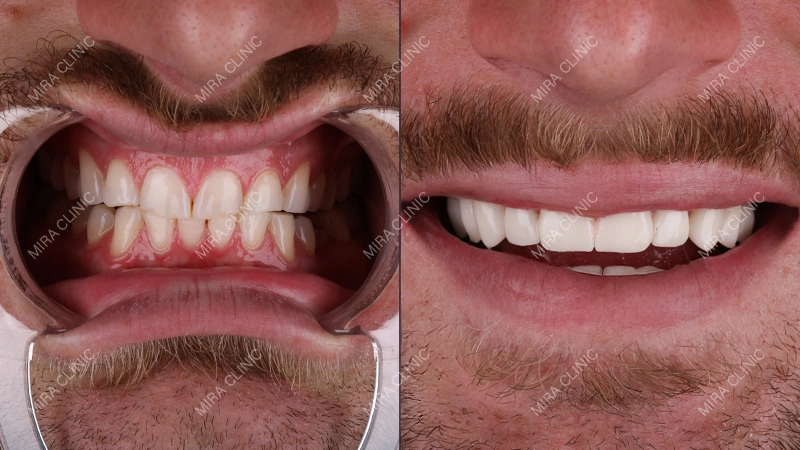 Veneers Result